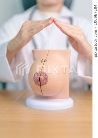 Doctor hand cover Breast Anatomy model. Breast Augmentation Surgery, October Breast Cancer Awareness month, implant, Diagnosis, Beauty woman enlargement and medical education concept Doctor hand cover Breast Anatomy model. Breast Augmentation Surgery, October Breast Cancer Awareness month, implant, Diagnosis, Beauty woman enlargement and medical education concept 106967194