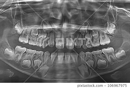X ray of child teeth X ray of child teeth 106967975