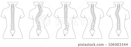 脊椎側彎的簡單圖示 106983344