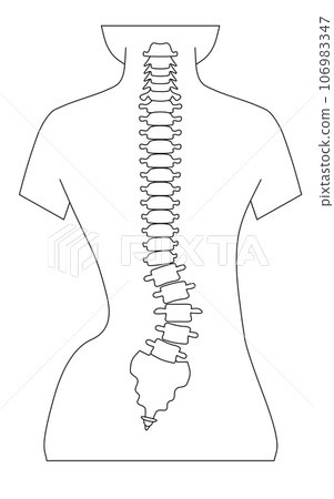 脊椎側彎的簡單圖示 106983347