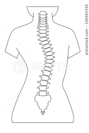 脊椎側彎的簡單圖示 106983348