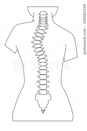 脊椎側彎的簡單圖示 106983349