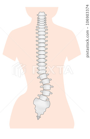 脊椎側彎的簡單圖示 脊椎側彎的簡單圖示 106983374