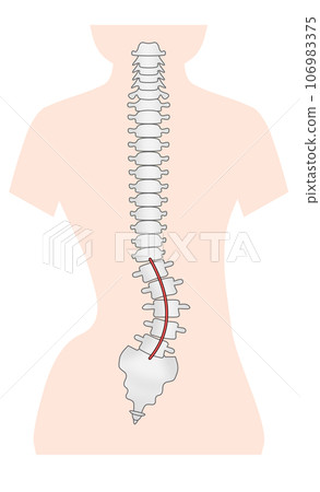 脊椎側彎的簡單圖示 脊椎側彎的簡單圖示 106983375