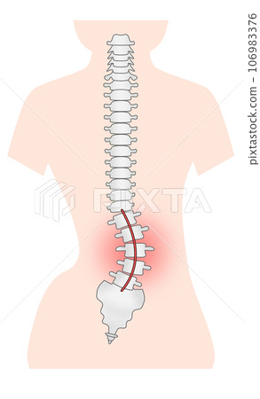 脊椎側彎的簡單圖示 106983376