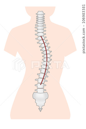 A simple illustration of a scoliotic spine A simple illustration of a scoliotic spine 106983381