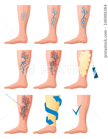 Stages or types of varicose veins development. Medical poster or disease infographic. Image of healthy and diseased legs. Vector illustration in flat style Stages or types of varicose veins development. Medical poster or disease infographic. Image of healthy and diseased legs. Vector illustration in flat style 106998364