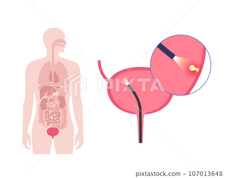Cystoscopy examination concept 107013648