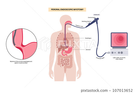 POEM medical poster POEM medical poster 107013652
