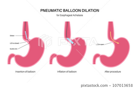 Endoscopic pneumatic dilation 107013658