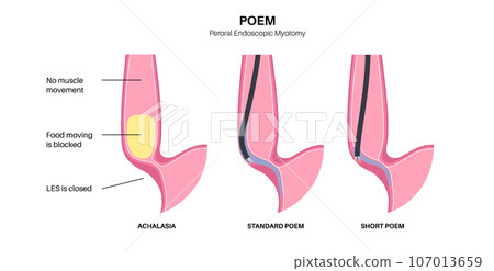 POEM medical poster 107013659