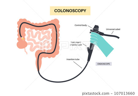 Colonoscopy medical procedure 107013660
