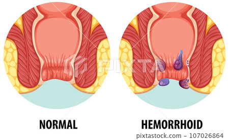 Comparison of Normal and Hemorrhoid in Human Anatomy Comparison of Normal and Hemorrhoid in Human Anatomy 107026864