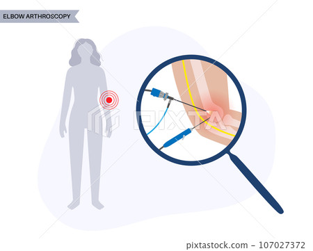 Elbow arthroscopy surgery 107027372