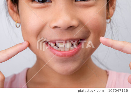 Close-up of cute young girl smiling wide, showing empty space with growing first front teeth. Little girl with big smile and missing milk teeth. Dental hygiene concept 107047116