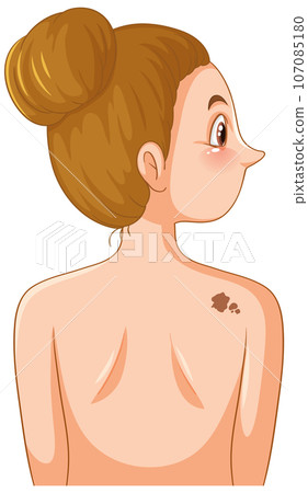 Abnormal Skin Cell Growth Leading to Cancer 107085180