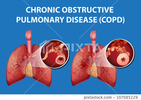 Science Education of Human Anatomy: Chronic Obstructive Pulmonary Disease Science Education of Human Anatomy: Chronic Obstructive Pulmonary Disease 107085229