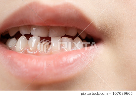 The teeth of a six-year-old child, a crookedly growing incisor in place of a lost milk tooth. The teeth of a six-year-old child, a crookedly growing incisor in place of a lost milk tooth. 107089605