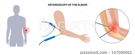 Elbow arthroscopy surgery 107090062