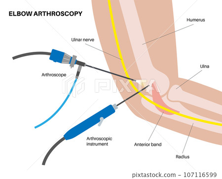 Elbow arthroscopy surgery Elbow arthroscopy surgery 107116599