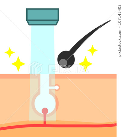 Illustration of a cross section of hair being removed by laser hair removal to remove unwanted hair Illustration of a cross section of hair being removed by laser hair removal to remove unwanted hair 107143402