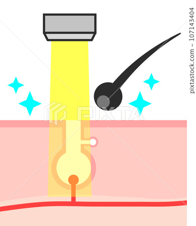 Illustration of a cross section of hair being removed by laser hair removal to remove unwanted hair Illustration of a cross section of hair being removed by laser hair removal to remove unwanted hair 107143404
