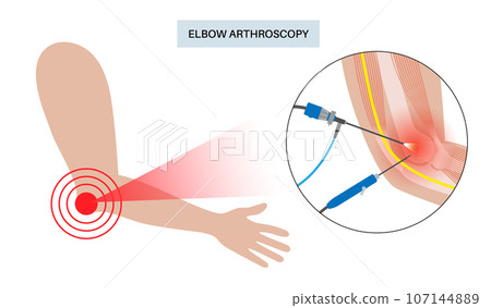 Elbow arthroscopy surgery 107144889