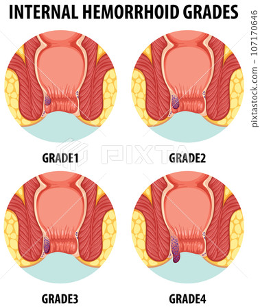 Illustrated Anatomy of Human Internal Hemorrhoids in Different Grades Illustrated Anatomy of Human Internal Hemorrhoids in Different Grades 107170646