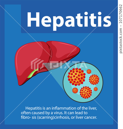 Close-Up of Hepatitis Virus Cell on Human Liver Anatomy Close-Up of Hepatitis Virus Cell on Human Liver Anatomy 107170662