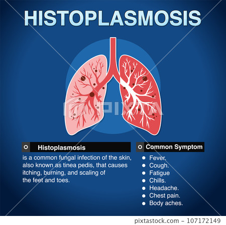 Informative poster of Histoplasmosis 107172149