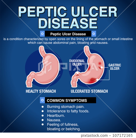 Peptic Ulcer Disease Explained Infographic 107172165