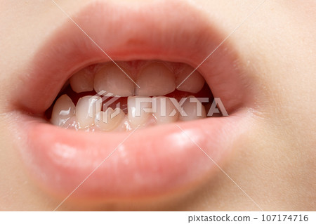 The teeth of a six-year-old child, a crookedly growing incisor in place of a lost milk tooth. The teeth of a six-year-old child, a crookedly growing incisor in place of a lost milk tooth. 107174716
