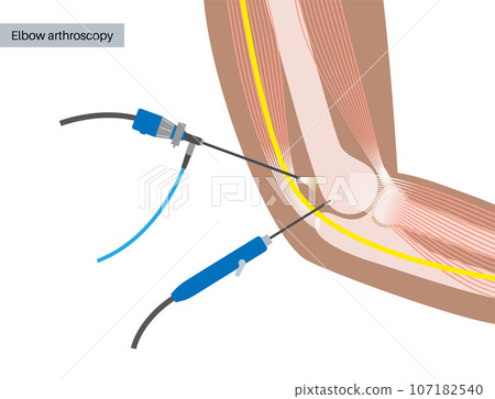 Elbow arthroscopy surgery Elbow arthroscopy surgery 107182540