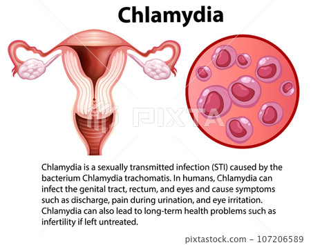 Chlamydia trachomatis with explanation 107206589