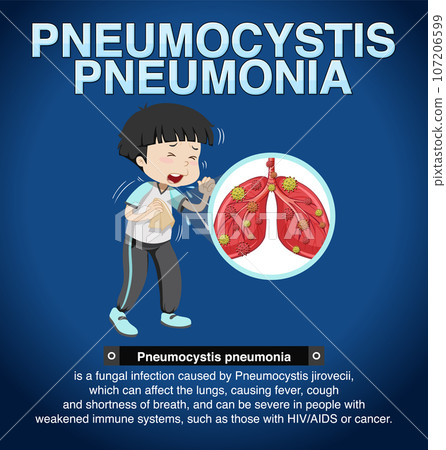 Informative poster of Pneumocystis Pneumonia Informative poster of Pneumocystis Pneumonia 107206599
