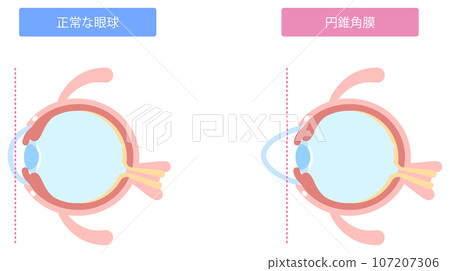 Illustration of keratoconus 107207306