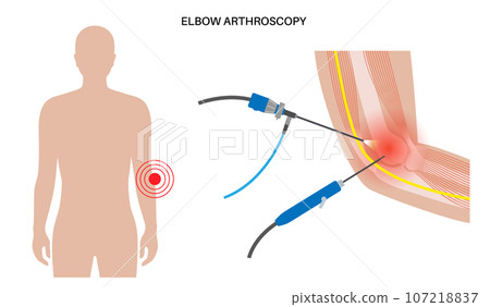 Elbow arthroscopy surgery 107218837
