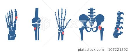 Osteomyelitis disease poster Osteomyelitis disease poster 107221292