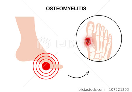 Osteomyelitis of feet Osteomyelitis of feet 107221293