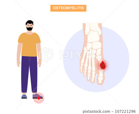 Osteomyelitis of feet Osteomyelitis of feet 107221296
