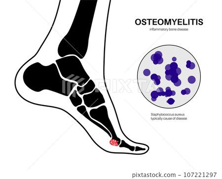 Osteomyelitis of feet 107221297