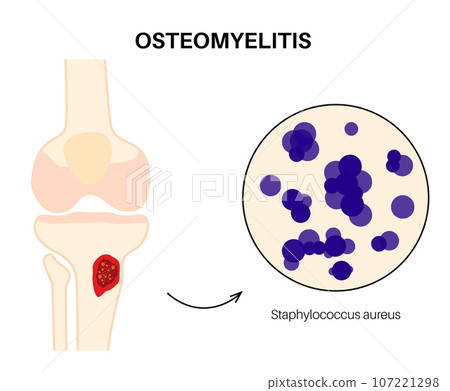 Tibia bone osteomyelitis Tibia bone osteomyelitis 107221298