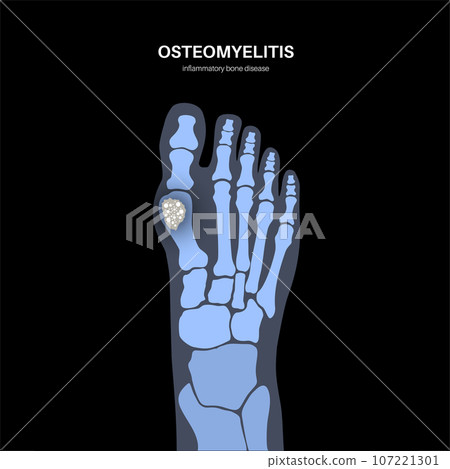 Osteomyelitis of feet 107221301