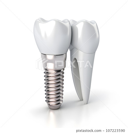 The concept of dental implant surgery. Image of implants on a white background The concept of dental implant surgery. Image of implants on a white background 107223590