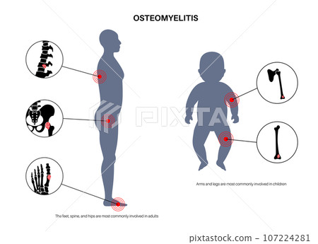 Osteomyelitis disease poster Osteomyelitis disease poster 107224281