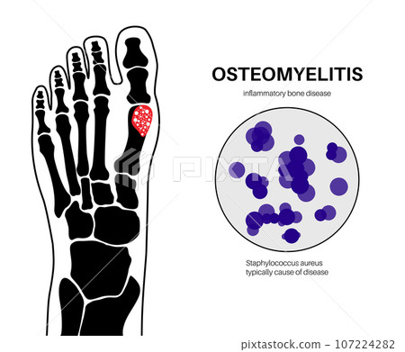 Osteomyelitis of feet 107224282