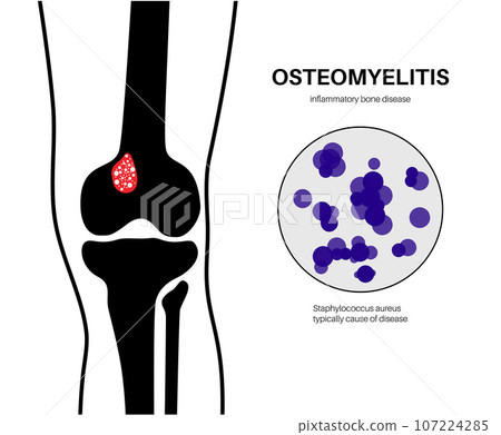 Tibia bone osteomyelitis 107224285