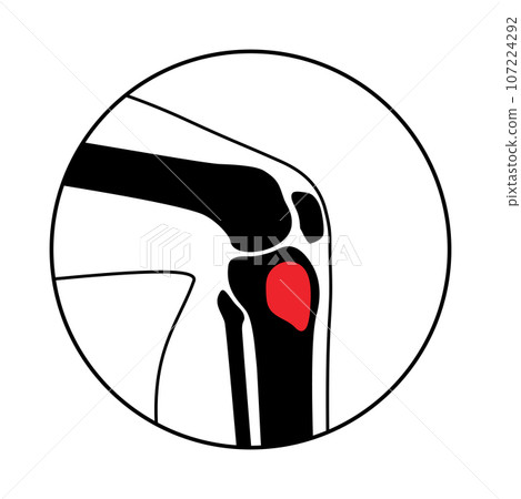 Tibia bone osteomyelitis Tibia bone osteomyelitis 107224292