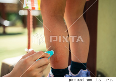 媽媽給孩子的腳塗止癢藥 107227649