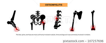Osteomyelitis disease poster 107257696
